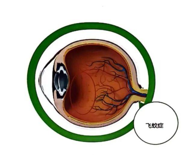 飛蚊癥治療最新突破，開啟視界新篇章